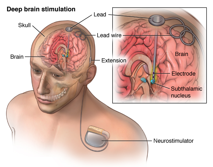 Deep Brain Stimulation